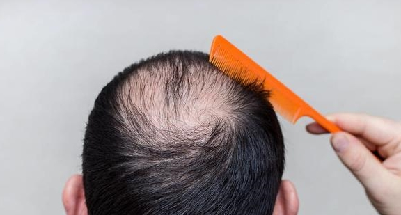 经常脱发的人，可能是缺少这几种元素，及时补充或能让你发量喜人